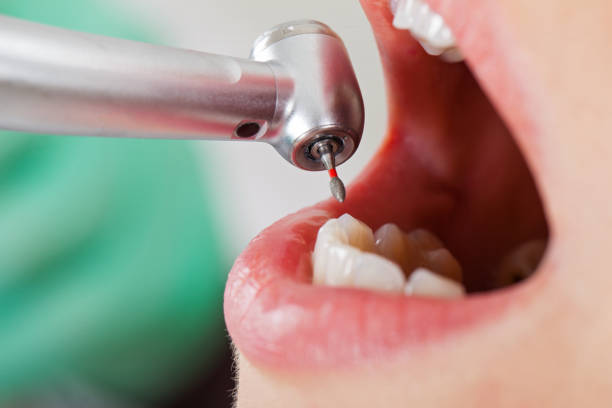 Best Emergency Treatment for Dental Infections or Abscesses in Baird, TX
